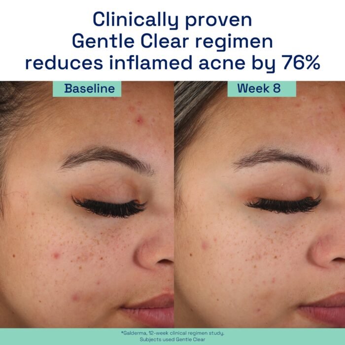 Cetaphil Gentle Clear Mattifying Acne Moisturizer – 89ml - Image 4