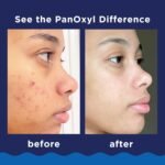 Panoxyl Acne Foaming Wash with 10% Benzoyl Peroxide for Maximum Strength 156g - Image 4