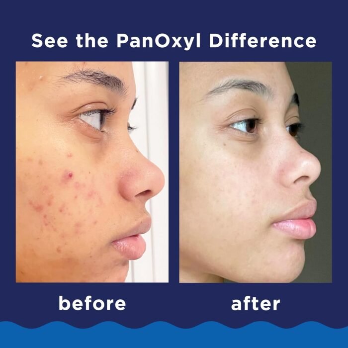 Panoxyl Acne Foaming Wash with 10% Benzoyl Peroxide for Maximum Strength 156g - Image 4