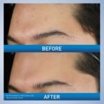 CeraVe Acne Foaming Cream Wash ( benzoyl peroxide 10% ) – 150ml - Image 4