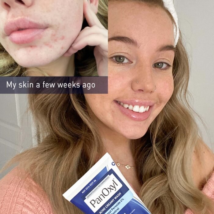 PanOxyl Acne Creamy Wash – 170g - Image 3